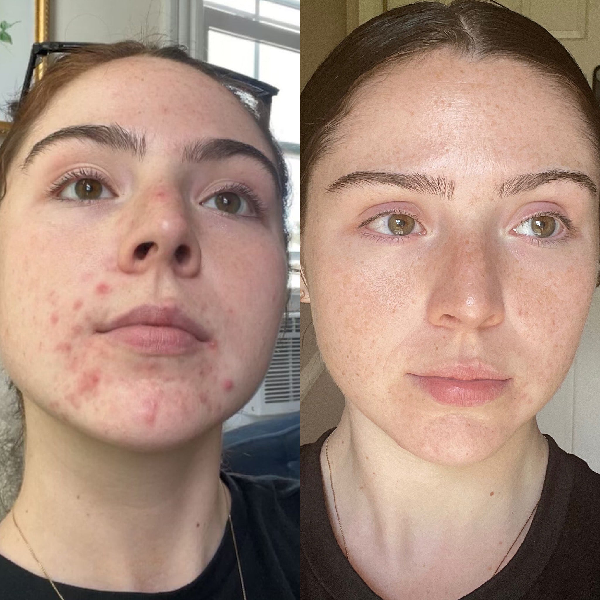 Professional Skin Cleaning vs. At-Home Skincare — What’s the Real Difference?
